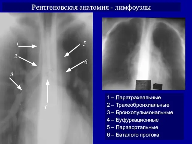 Рентгеновская анатомия - лимфоузлы 1 1 – Паратрахеальные 2 – Трахеобронхиальные