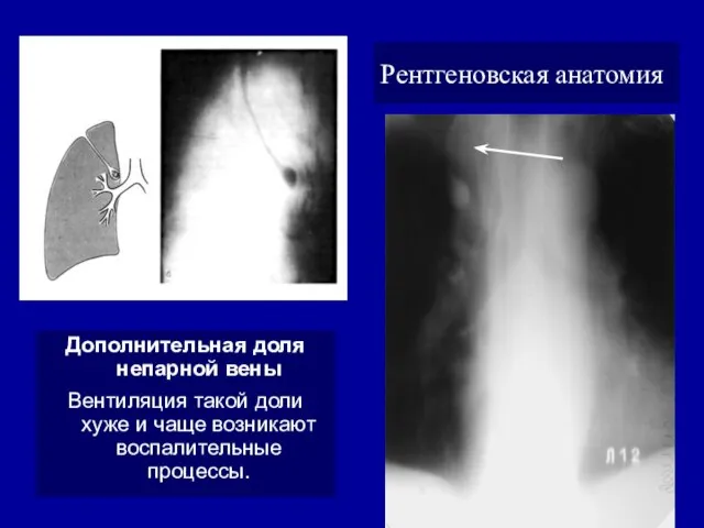 Рентгеновская анатомия Дополнительная доля непарной вены Вентиляция такой доли хуже и чаще возникают воспалительные процессы.