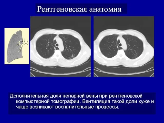 Рентгеновская анатомия Дополнительная доля непарной вены при рентгеновской компьютерной томографии. Вентиляция