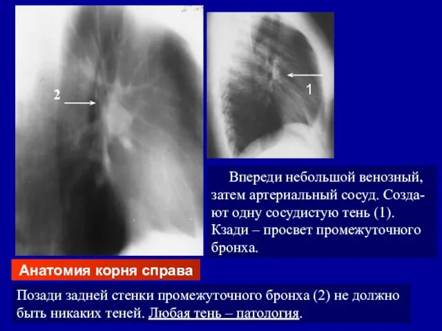 Анатомия корня справа Впереди небольшой венозный, затем артериальный сосуд. Созда-ют одну