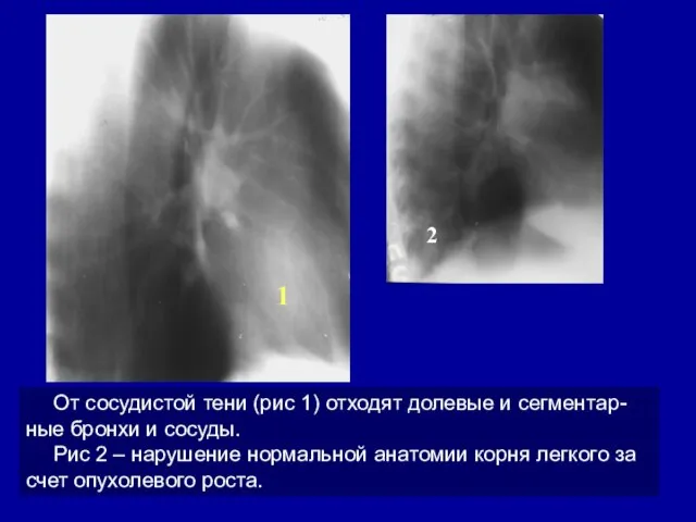 От сосудистой тени (рис 1) отходят долевые и сегментар-ные бронхи и