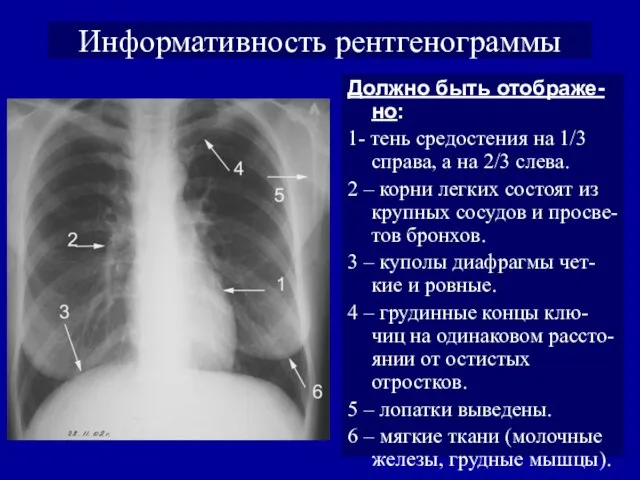 Информативность рентгенограммы Должно быть отображе-но: 1- тень средостения на 1/3 справа,