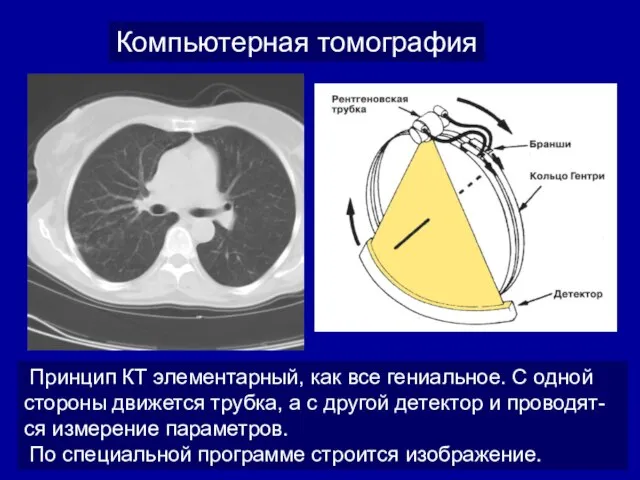 Компьютерная томография Принцип КТ элементарный, как все гениальное. С одной стороны