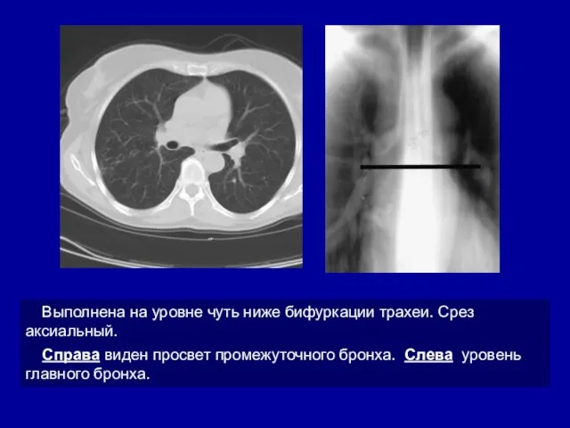 Выполнена на уровне чуть ниже бифуркации трахеи. Срез аксиальный. Справа виден