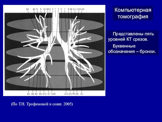 Компьютерная томография Представлены пять уровней КТ срезов. Буквенные обозначения – бронхи.