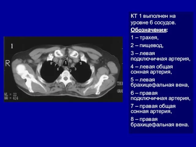 1 КТ 1 выполнен на уровне 6 сосудов. Обозначения: 1 –