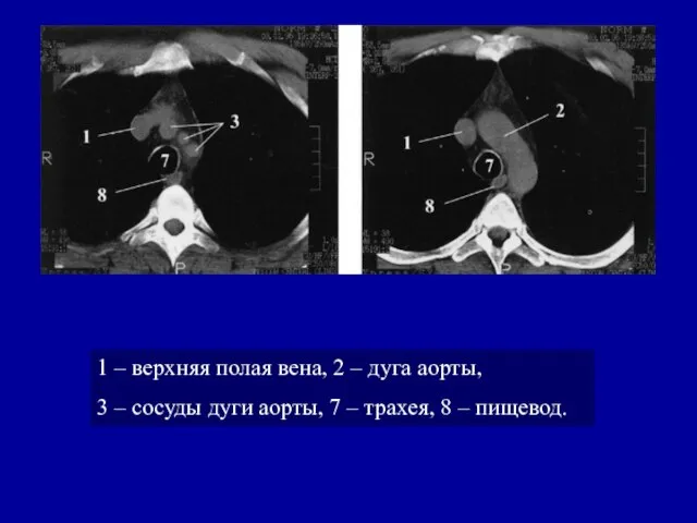 1 – верхняя полая вена, 2 – дуга аорты, 3 –