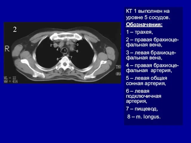 2 КТ 1 выполнен на уровне 5 сосудов. Обозначения: 1 –