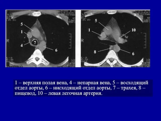 1 – верхняя полая вена, 4 – непарная вена, 5 –