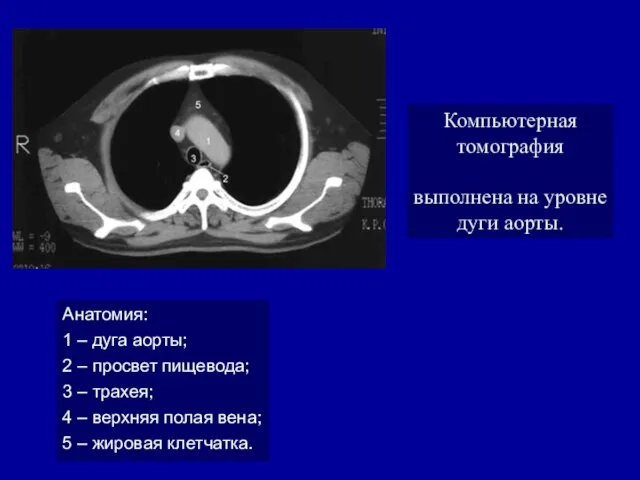 Компьютерная томография выполнена на уровне дуги аорты. Анатомия: 1 – дуга