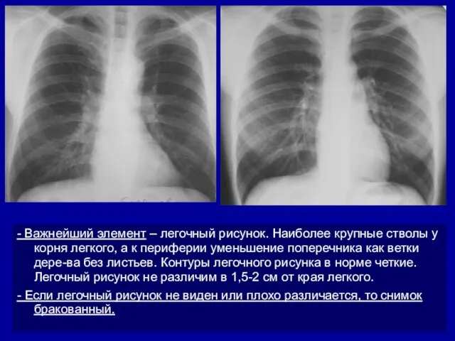 - Важнейший элемент – легочный рисунок. Наиболее крупные стволы у корня