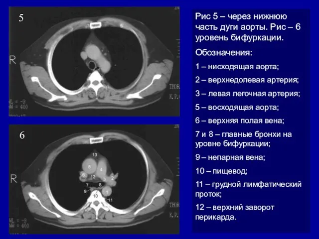 5 6 Рис 5 – через нижнюю часть дуги аорты. Рис