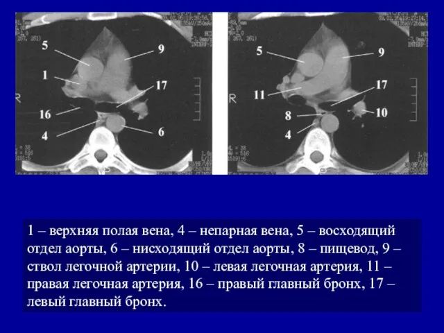 1 – верхняя полая вена, 4 – непарная вена, 5 –