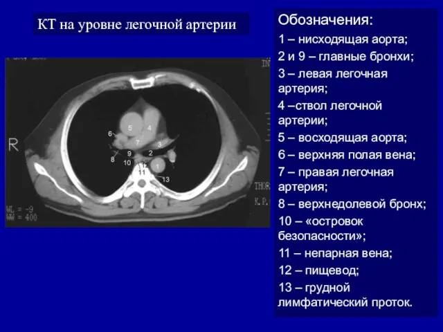 КТ на уровне легочной артерии Обозначения: 1 – нисходящая аорта; 2