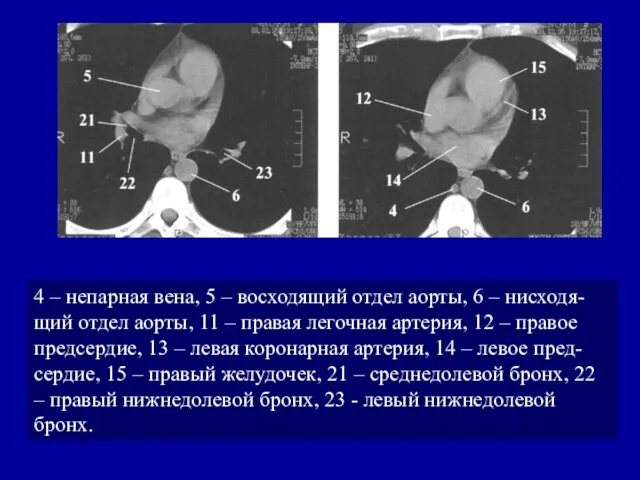 4 – непарная вена, 5 – восходящий отдел аорты, 6 –