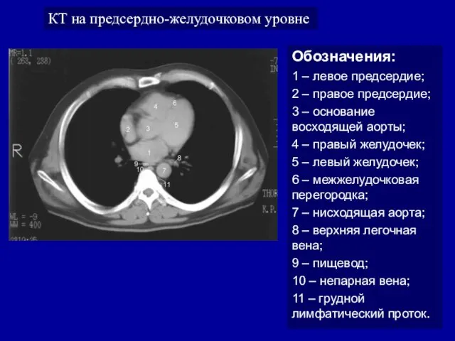 КТ на предсердно-желудочковом уровне Обозначения: 1 – левое предсердие; 2 –