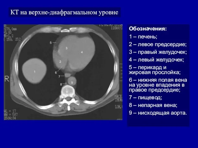 КТ на верхне-диафрагмальном уровне Обозначения: 1 – печень; 2 – левое