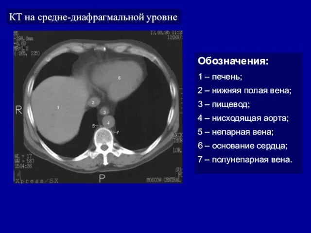 КТ на средне-диафрагмальной уровне Обозначения: 1 – печень; 2 – нижняя