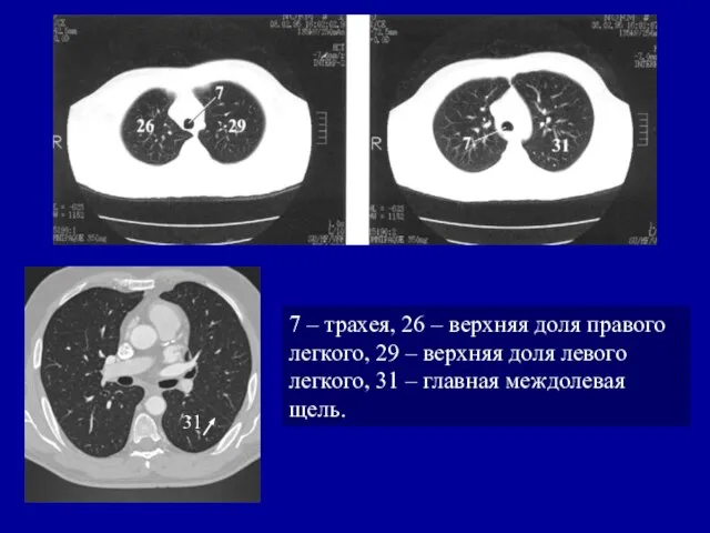 7 – трахея, 26 – верхняя доля правого легкого, 29 –