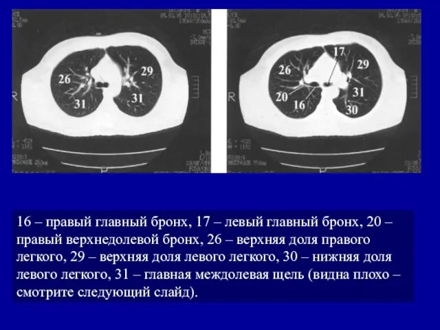 16 – правый главный бронх, 17 – левый главный бронх, 20