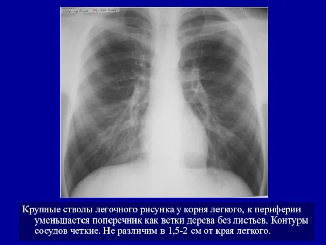 Крупные стволы легочного рисунка у корня легкого, к периферии уменьшается поперечник