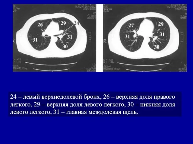 24 – левый верхнедолевой бронх, 26 – верхняя доля правого легкого,