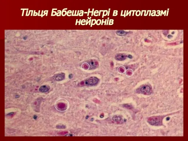Тільця Бабеша-Негрі в цитоплазмі нейронів