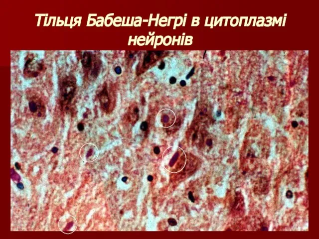 Тільця Бабеша-Негрі в цитоплазмі нейронів
