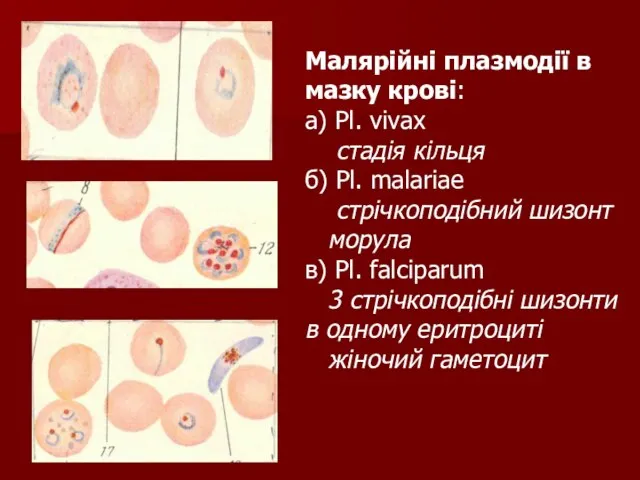 Малярійні плазмодії в мазку крові: а) Pl. vivax стадія кільця б)