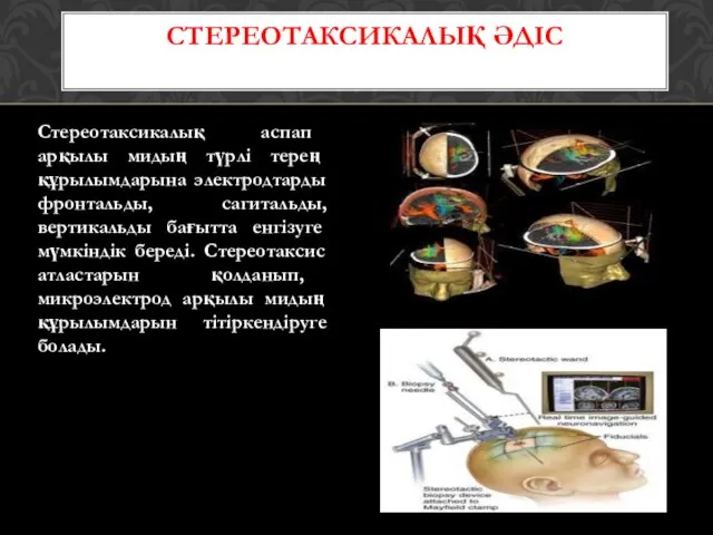 Стереотаксикалық аспап арқылы мидың түрлі терең құрылымдарына электродтарды фронтальды, сагитальды, вертикальды