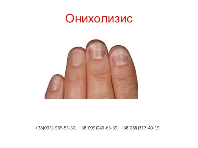 Онихолизис +38(093)-965-53-30, +38(099)049-63-39, +38(068)317-40-19