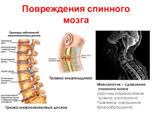 Травма «ныряльщика» Миелопатия – сдавление спинного мозга (причины:перенесённая травма, воспаление Позвонков,
