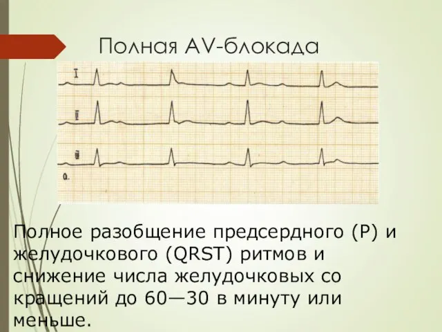 Полная AV-блокада Полное разобщение предсердного (Р) и желудочкового (QRST) ритмов и