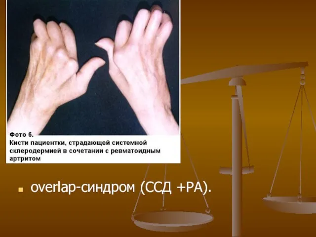 overlap-синдром (ССД +РА).