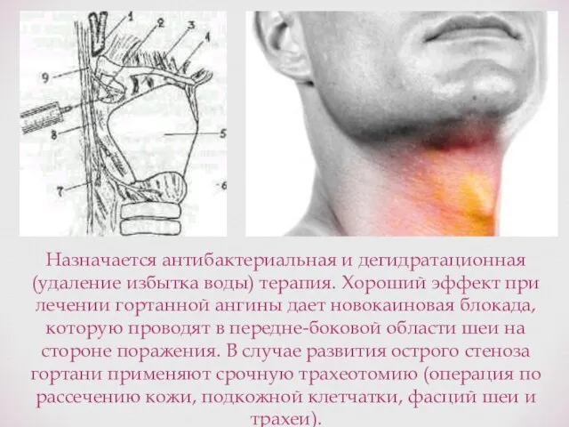 Назначается антибактериальная и дегидратационная (удаление избытка воды) терапия. Хороший эффект при