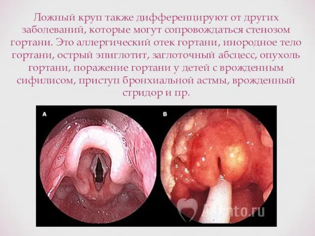 Ложный круп также дифференцируют от других заболеваний, которые могут сопровождаться стенозом