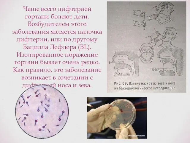 Чаще всего дифтерией гортани болеют дети. Возбудителем этого заболевания является палочка