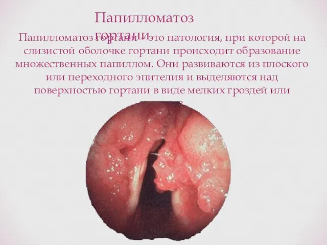 Папилломатоз гортани Папилломатоз гортани – это патология, при которой на слизистой