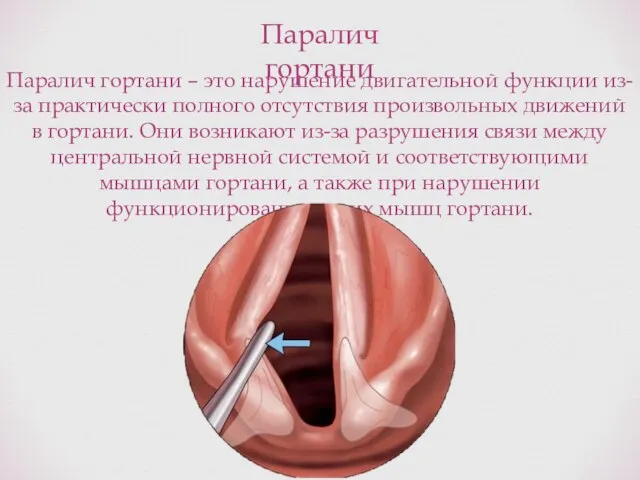 Паралич гортани Паралич гортани – это нарушение двигательной функции из-за практически