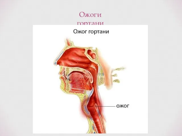 Ожоги гортани