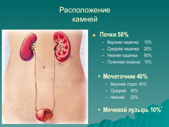 Расположение камней Почки 50% Верхняя чашечка 10% Средняя чашечка 20% Нижняя