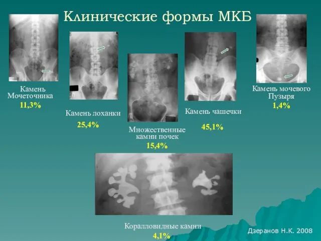 Клинические формы МКБ Камень мочевого Пузыря 1,4% Коралловидные камни 4,1% Камень