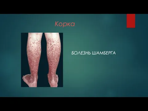 Корка БОЛЕЗНЬ ШАМБЕРГА