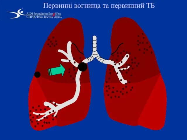 Первинні вогнища та первинний ТБ