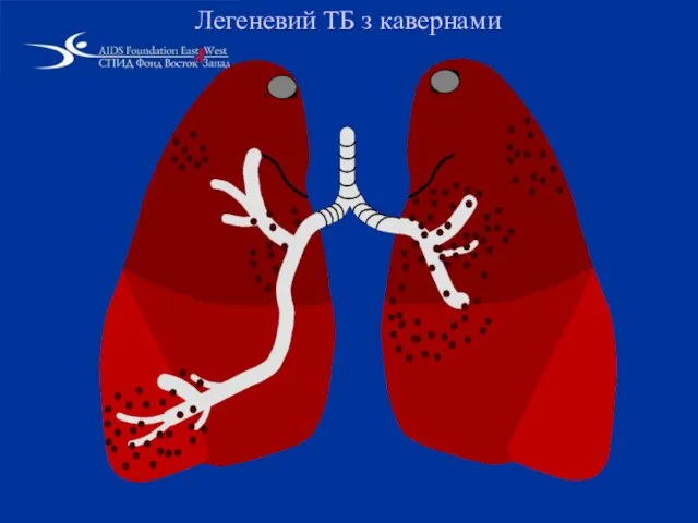 Легеневий TБ з кавернами