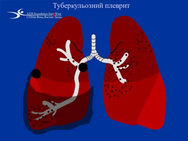 Туберкульозний плеврит