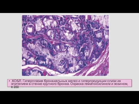ХОБЛ. Гиперплазия бронхиальных желез и гиперпродукции слизи их эпителием в стенке
