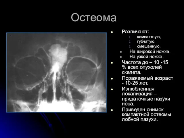 Остеома Различают: компактную, губчатую, смешанную. На широкой ножке. На узкой ножке.