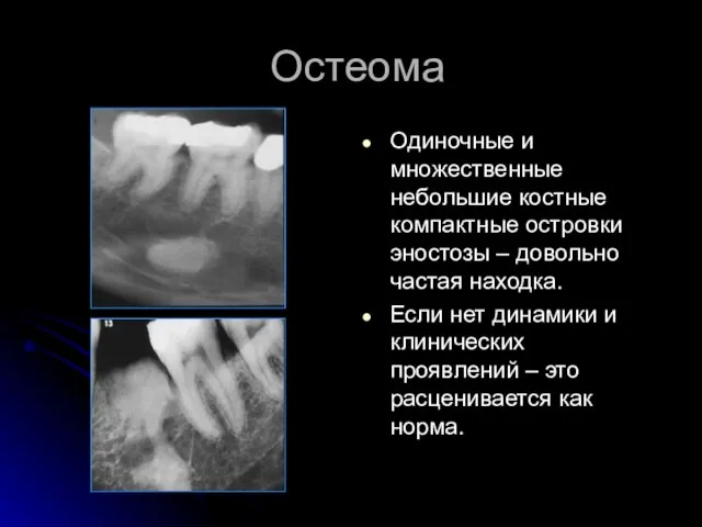 Остеома Одиночные и множественные небольшие костные компактные островки эностозы – довольно