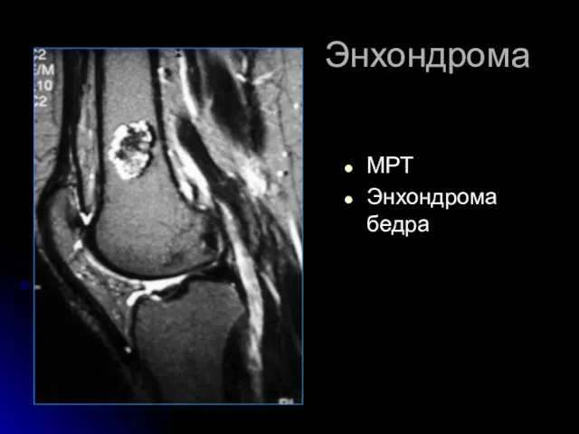 Энхондрома МРТ Энхондрома бедра